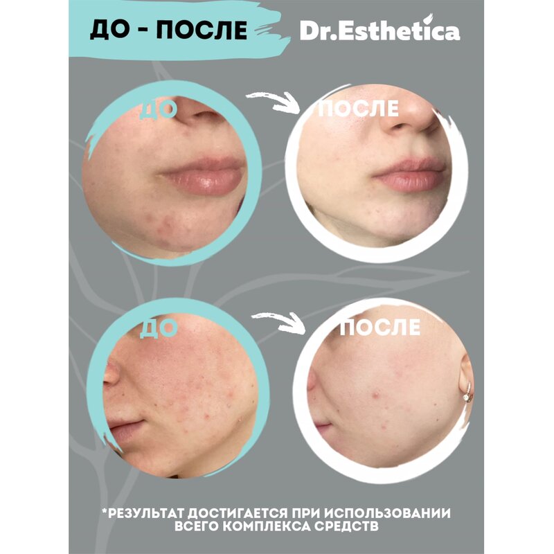 Гель-корректор Dr. Esthetica no acne для кожи, склонной к акне для взрослых 25+ туба 15мл