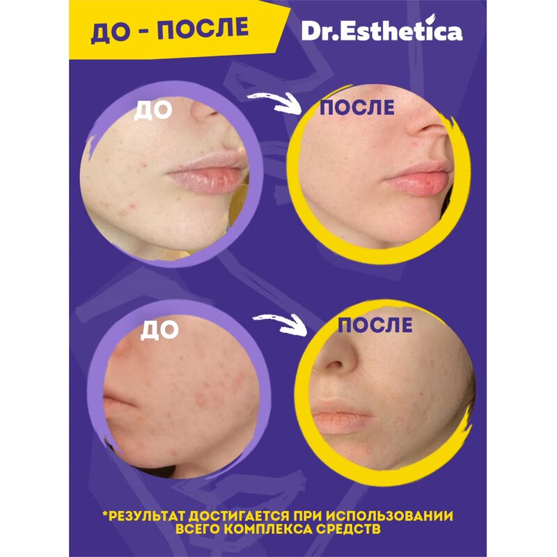 Крем-актив Dr. Esthetica no acne для кожи, склонной к акне для подростков с 14 до 18 лет туба 50 мл