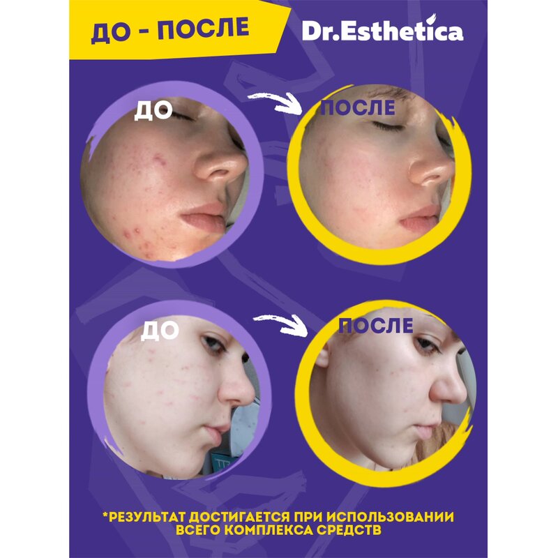 Гель-актив Dr. Esthetica no acne для кожи, склонной к акне для подростков с 14 до 18 лет 20 мл