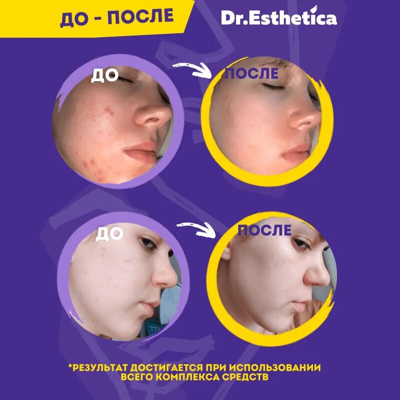 Маска-мульти пузырьковая Dr. Esthetica no acne для жирной кожи с 14 до 18 лет Yellow&Violet саше