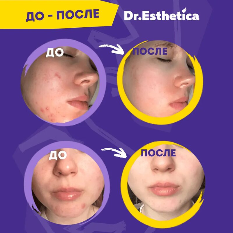 Маска-мульти пузырьковая Dr. Esthetica no acne для жирной кожи с 14 до 18 лет Pink&Green саше