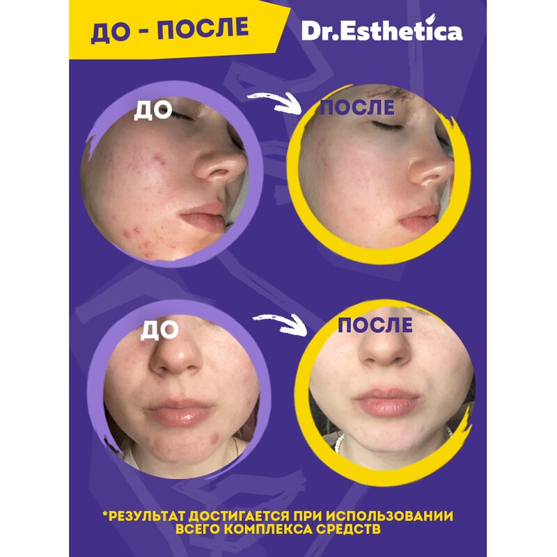 Пенка-актив Dr. Esthetica no acne для подростков 14-18 лет очищающая для жирной кожи, склонной к акне 200 мл