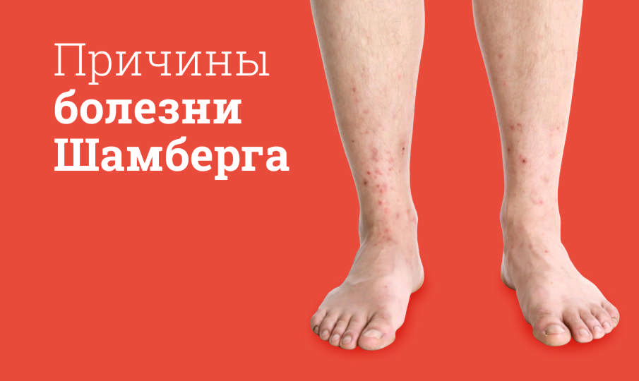 Болезнь Шамберга