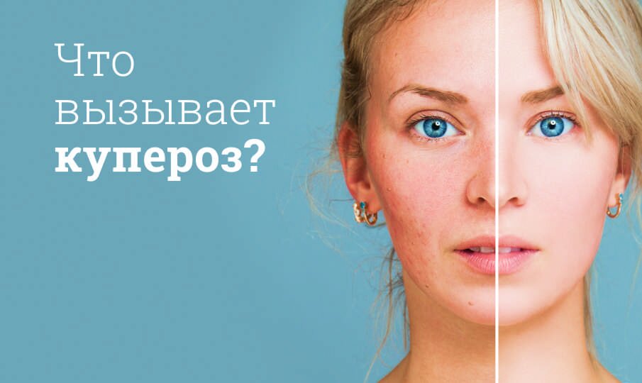 Лечение купероза