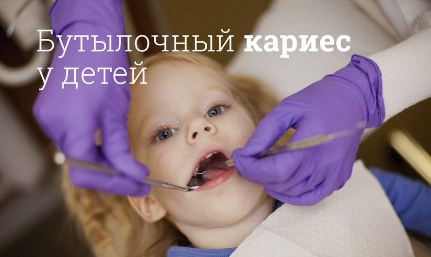Бутылочный кариес у детей: причины и лечение | Семейная стоматология