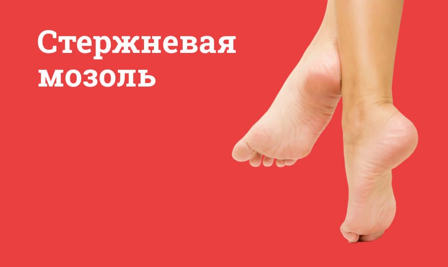 Стержневая мозоль