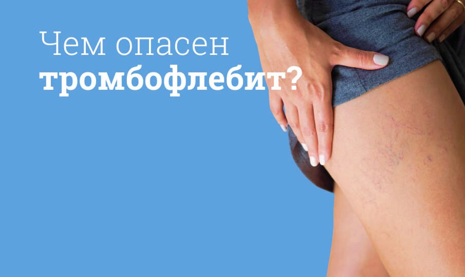 Тромбофлебит: симптомы и лечение