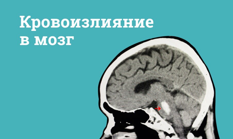 Кровоизлияние в мозг