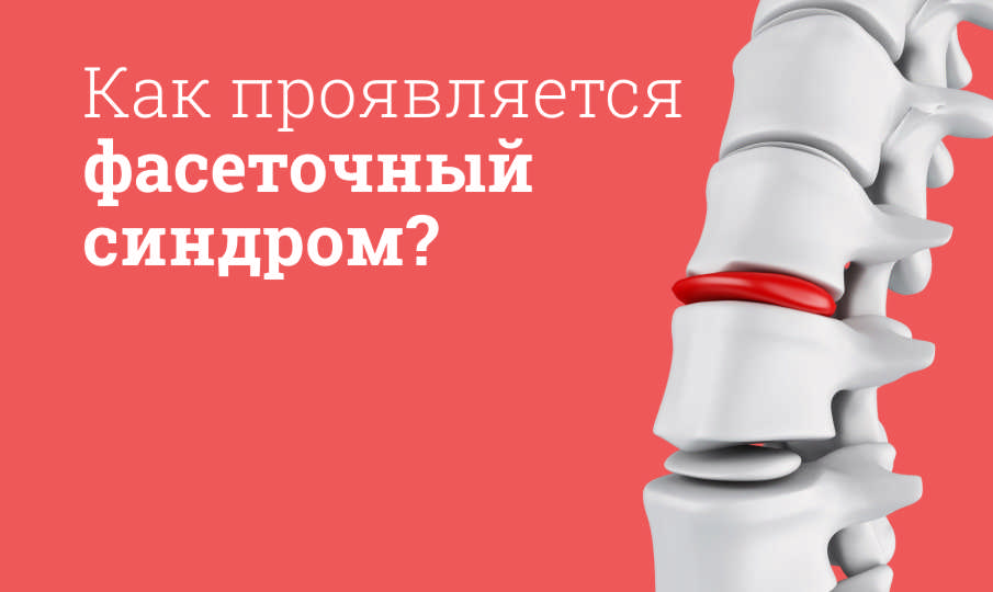 Фасеточный синдром