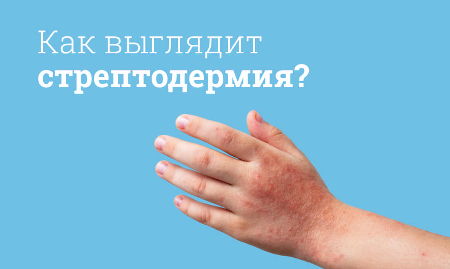 Лечение стрептодермии