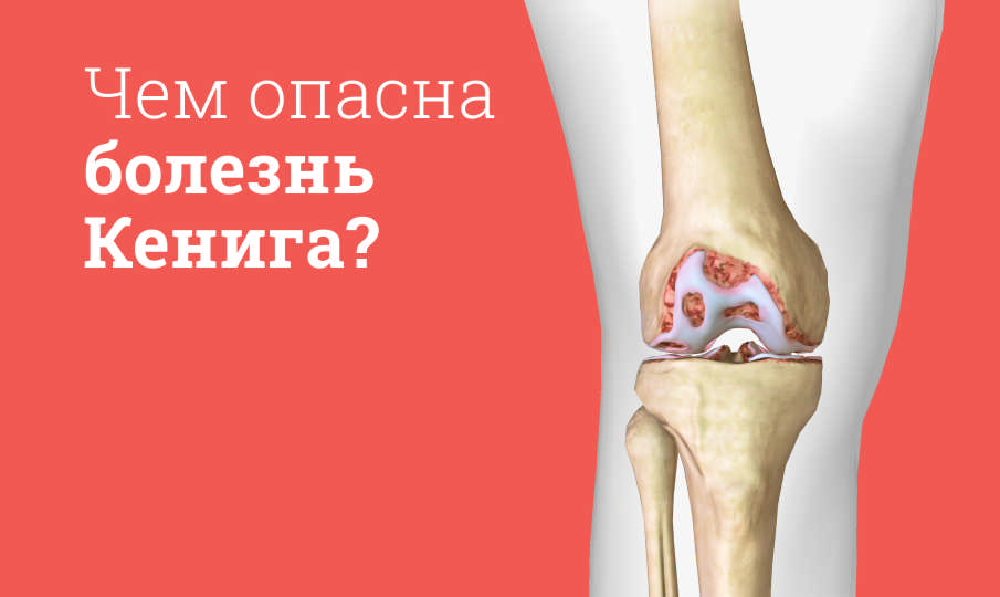Болезнь Кенига