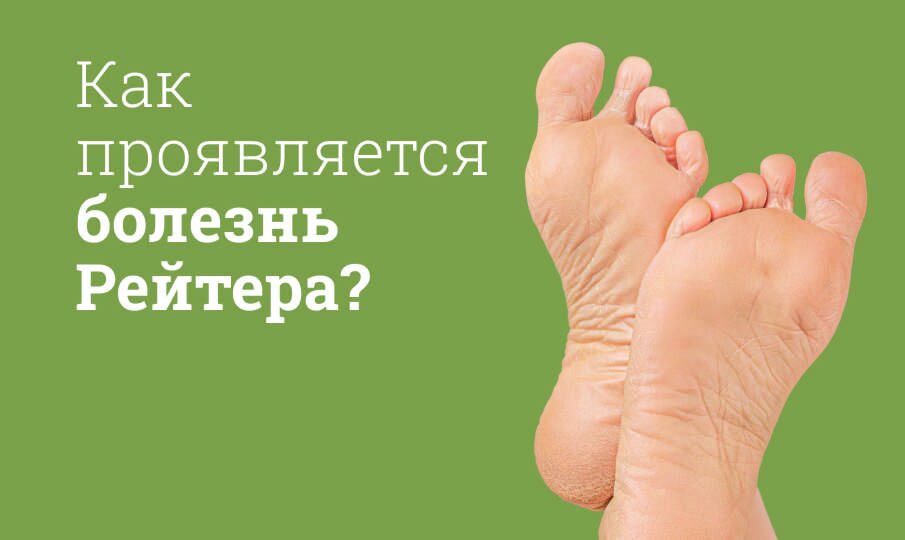 Симптомы и лечение болезни Рейтера