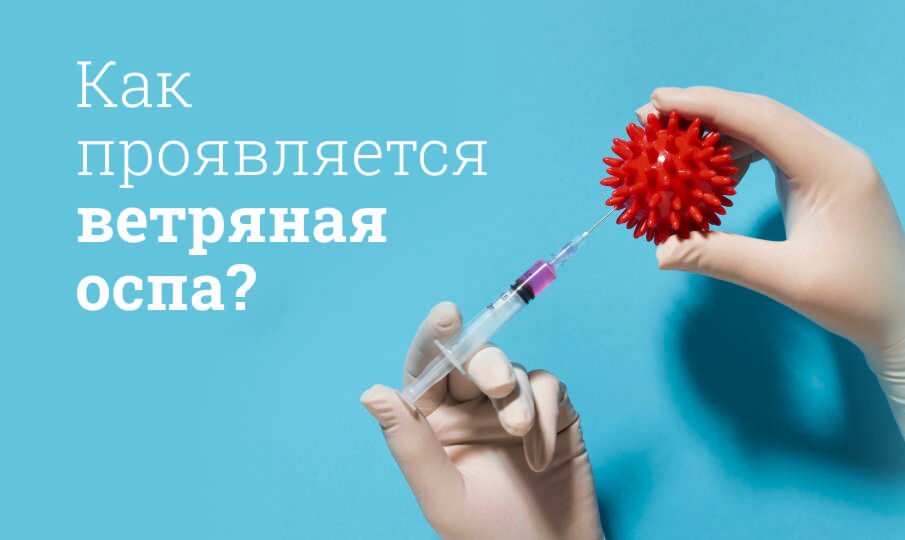 Ветряная оспа лечение консултация ID-CLINIC Санкт-петербург