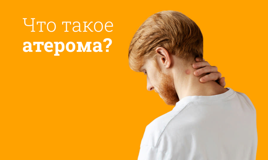 Лечение атеромы