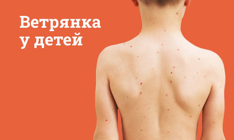 Ветрянка у детей: симптомы и лечение
