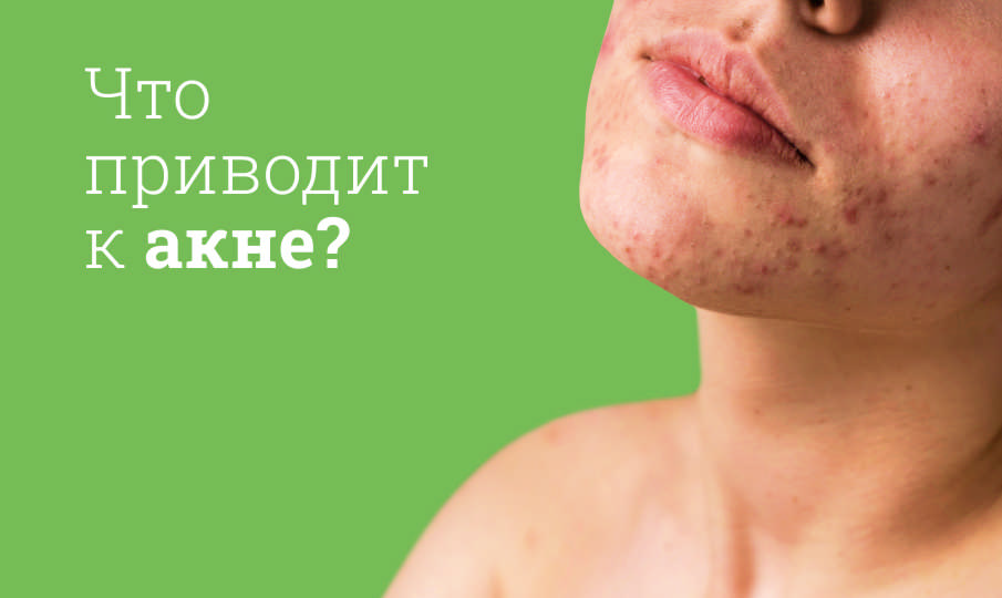 Лечение акне