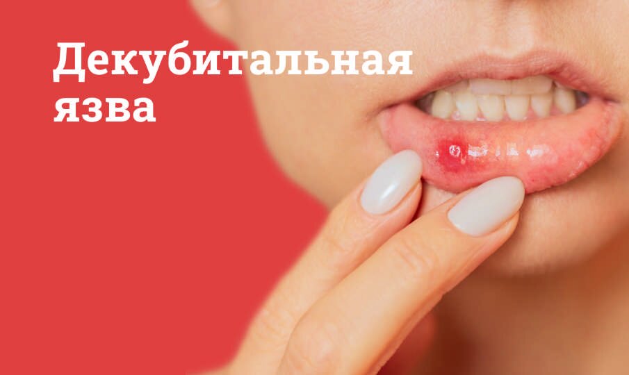 Декубитальная язва