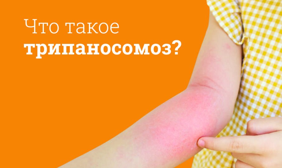 Трипаносомоз: симптомы и лечение