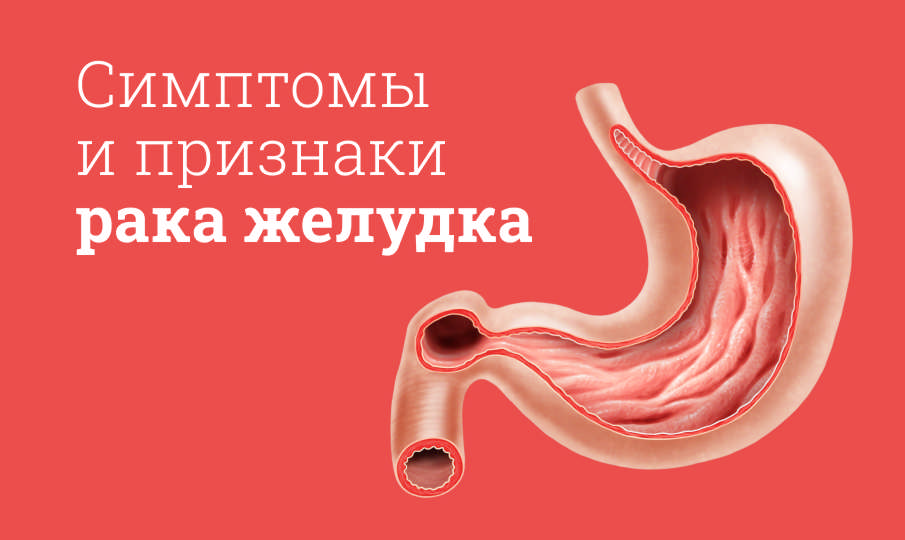 Симптомы рака желудка