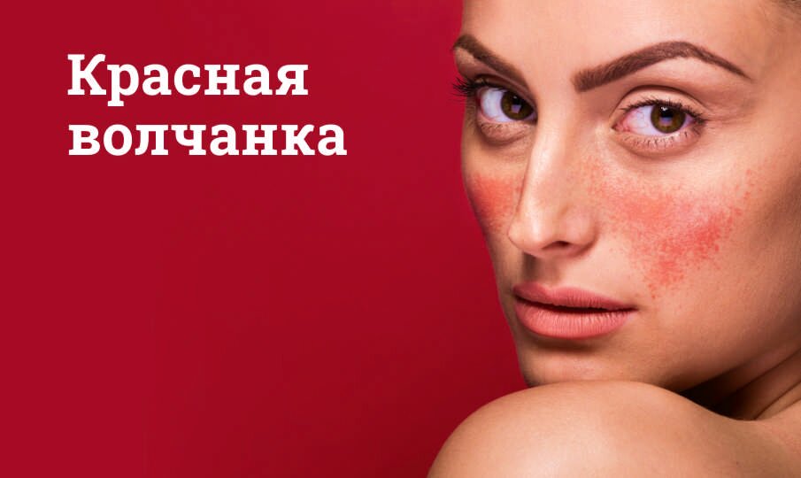 Красная волчанка: симптомы и лечение