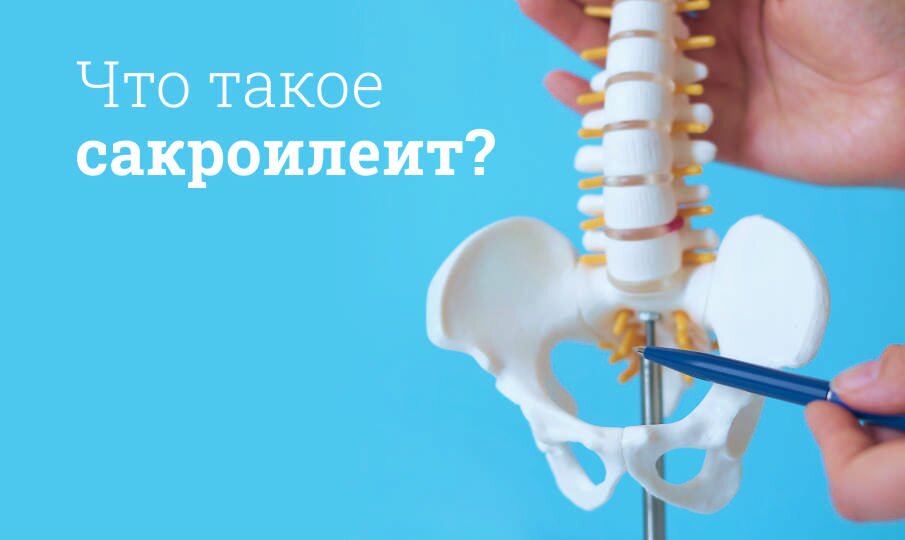 Сакроилеит: лечение и симптомы