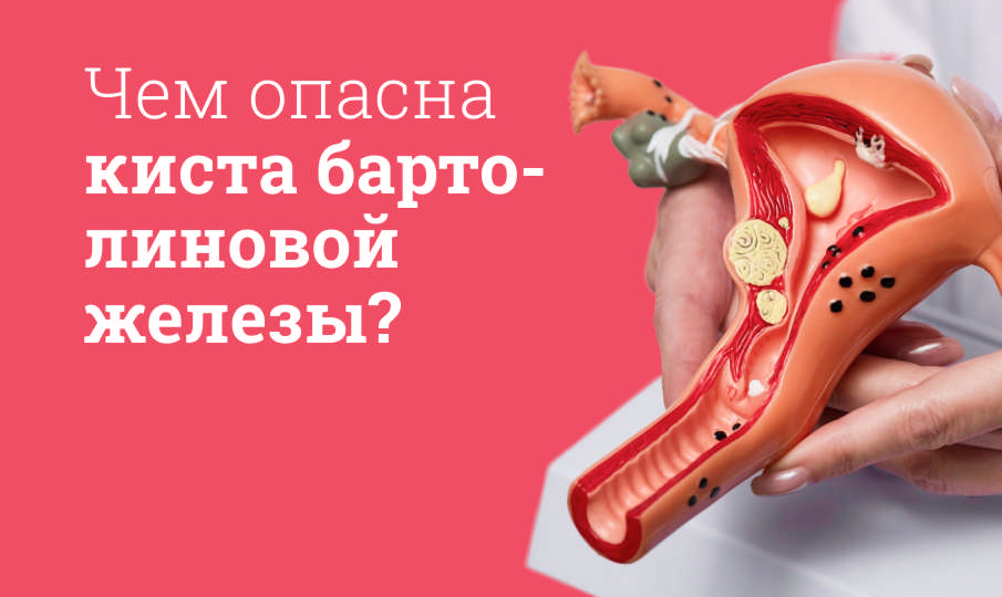 Киста бартолиновой железы