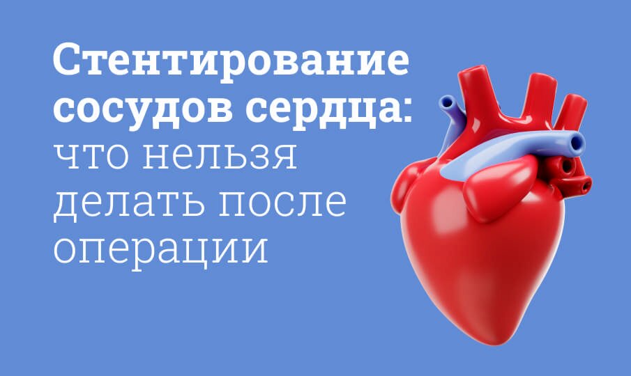 Стентирование сосудов сердца: что нельзя делать после операции