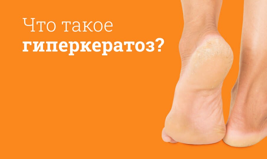 Лечение гиперкератоза