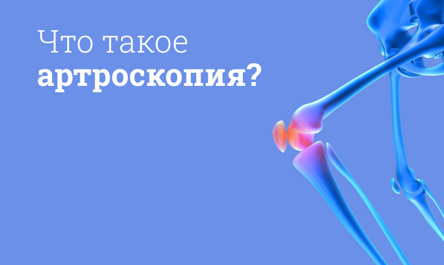 Что такое артроскопия?