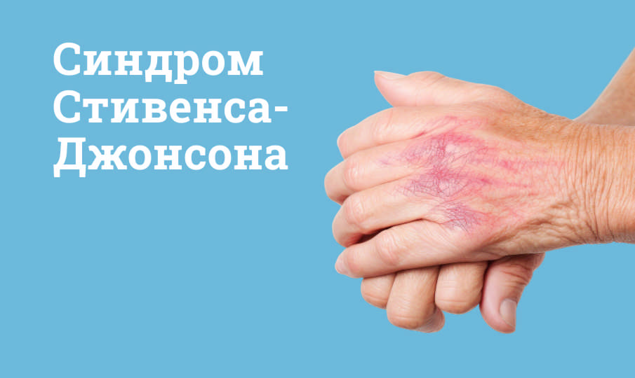 Синдром Стивенса-Джонсона