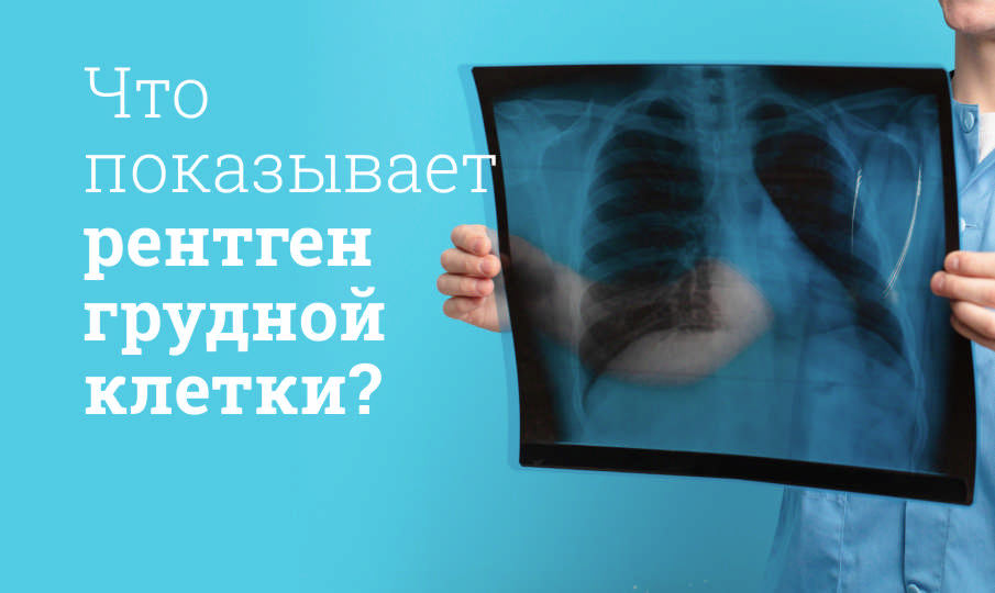 Что показывает рентген грудной клетки?