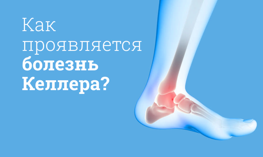 Болезнь Келлера