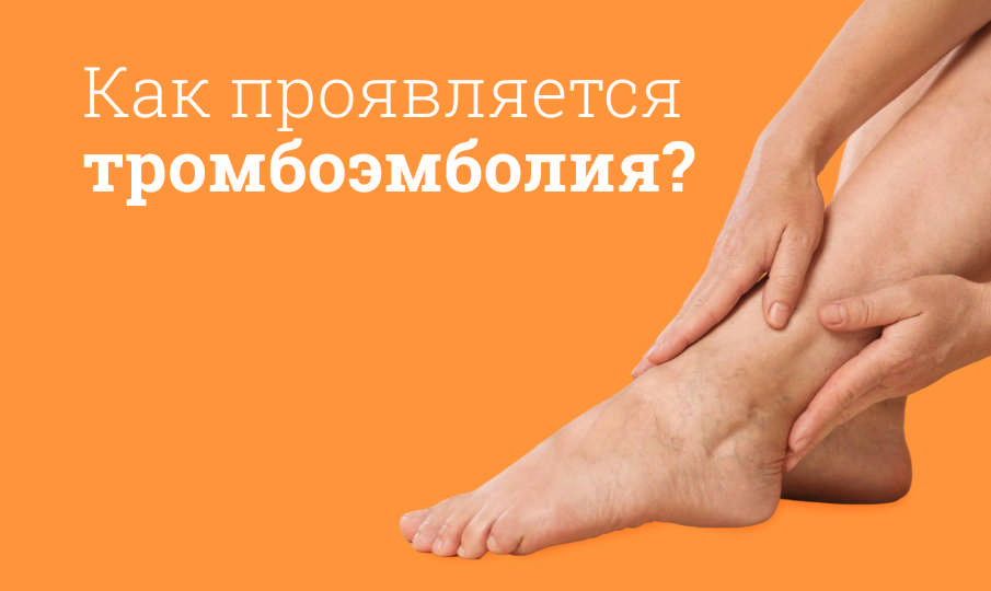Симптомы тромбоэмболии
