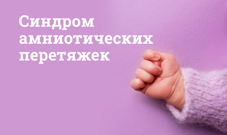 Синдром амниотических перетяжек