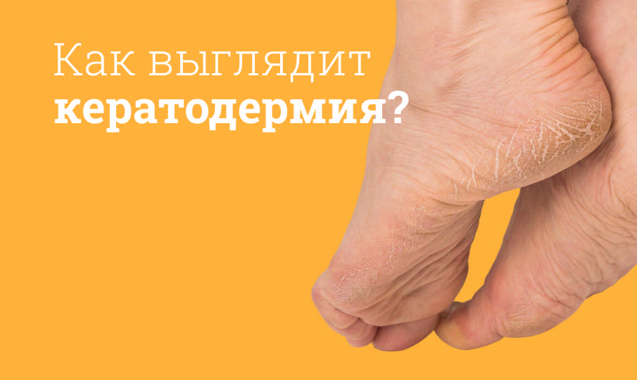 Что такое кератодермия?