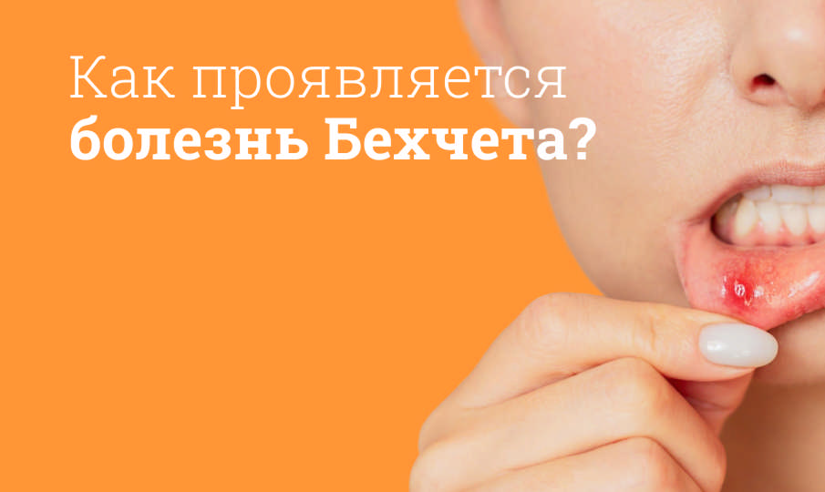 Болезнь Бехчета