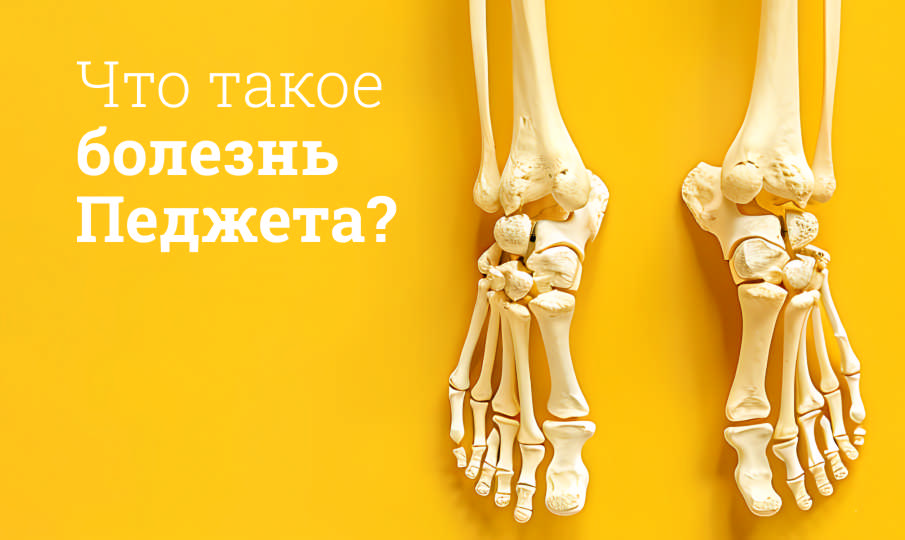 Болезнь Педжета