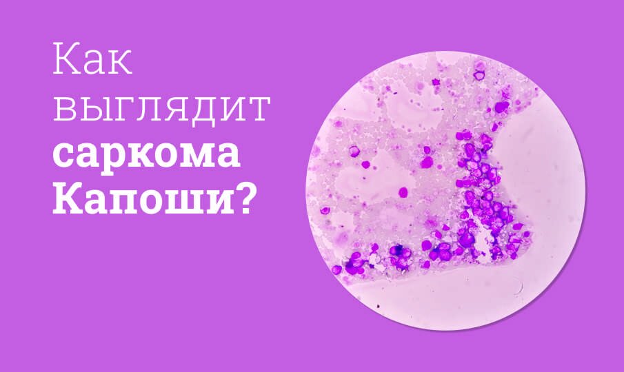 Саркома Капоши: симптомы и лечение