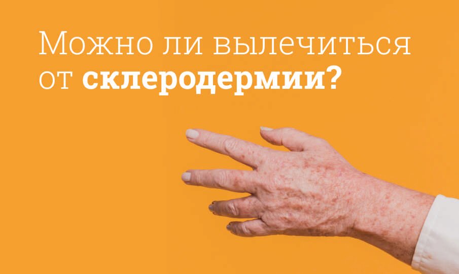 Склеродермия: симптомы и лечение