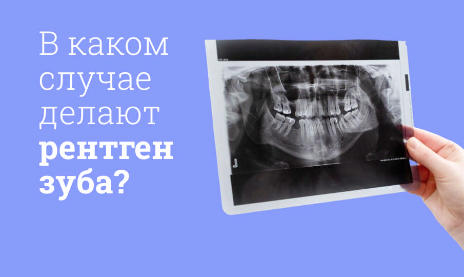 Рентген зубов
