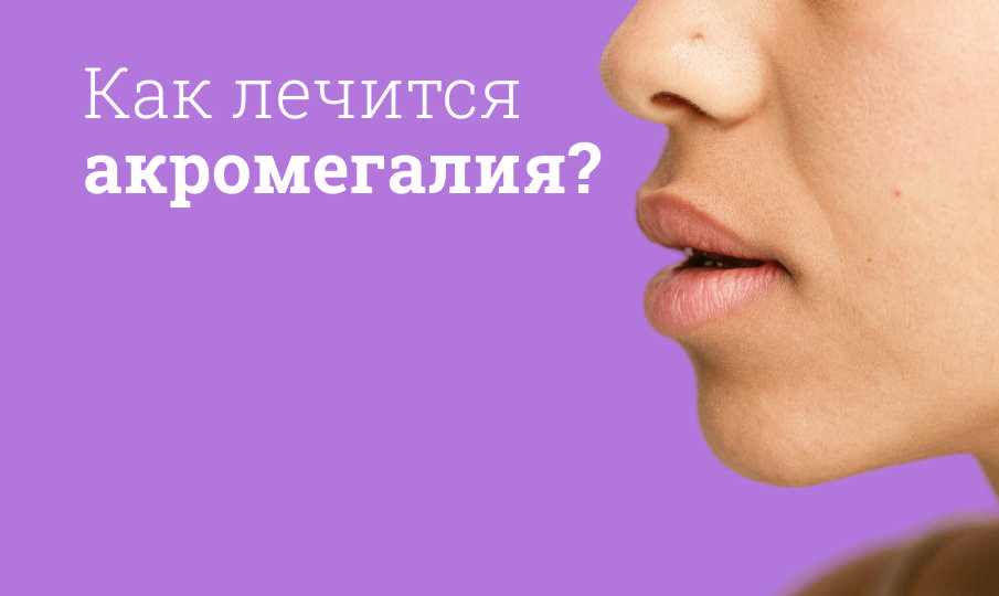 Что такое акромегалия?