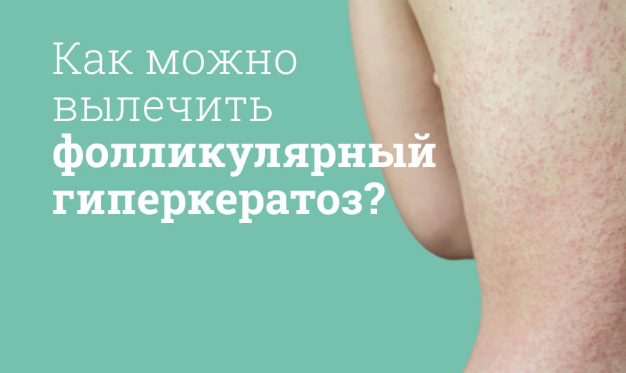 Лечение фолликулярного гиперкератоза