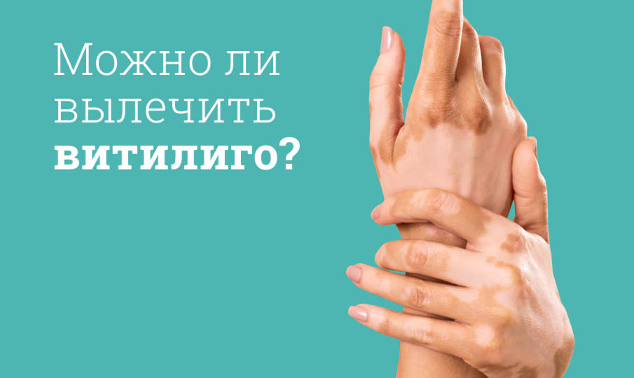 Лечение витилиго