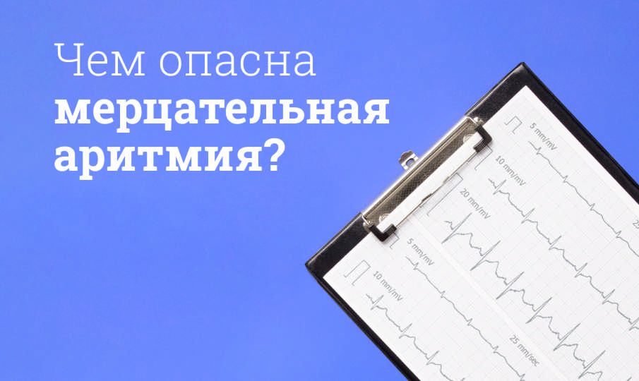 Симптомы и лечение мерцательной аритмии