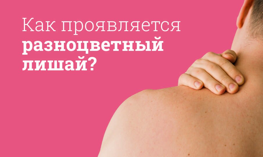 Разноцветный лишай на коже