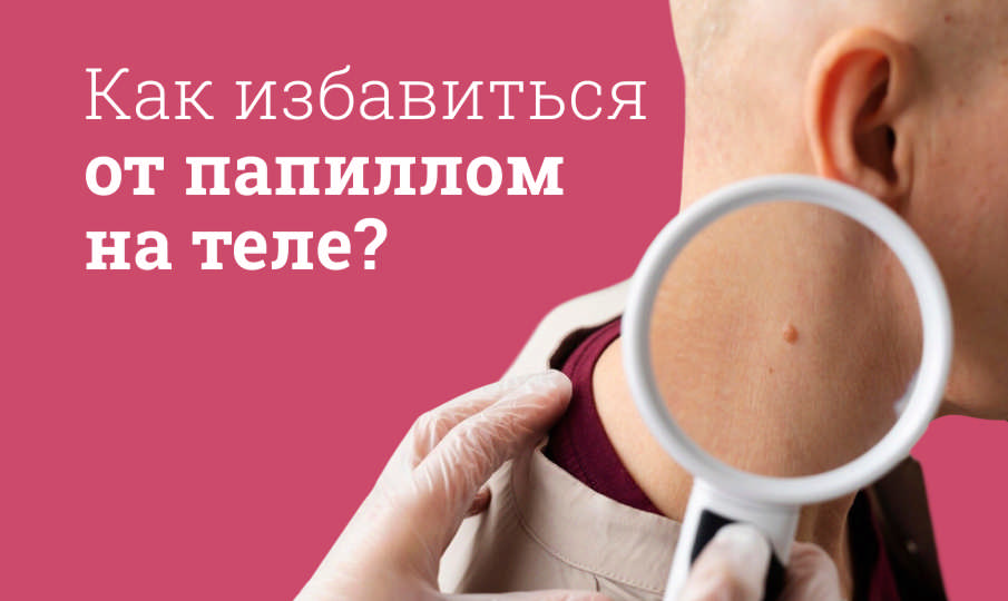 Как избавиться от папиллом на теле?