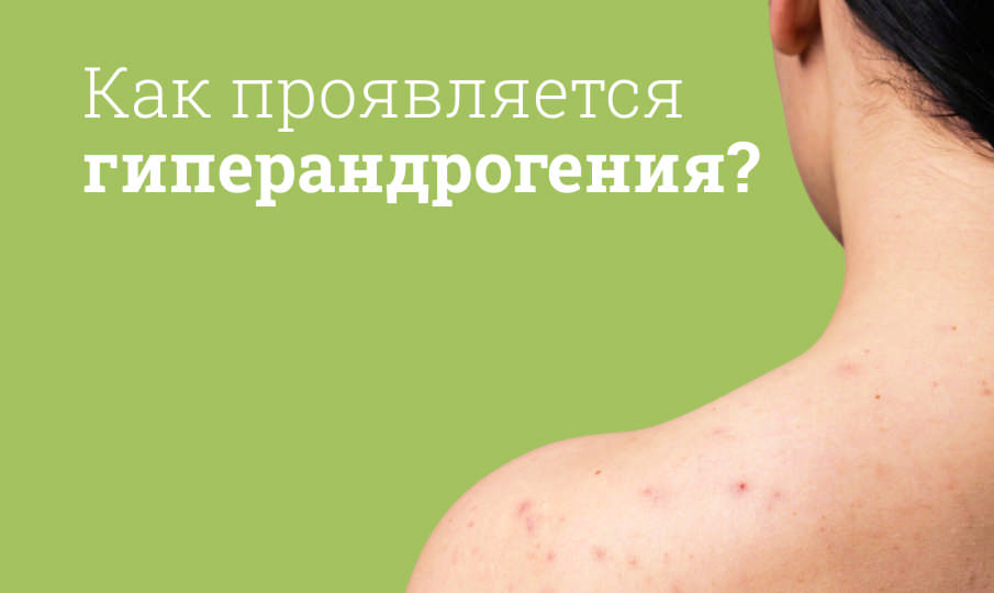 Что такое гиперандрогения у женщин?