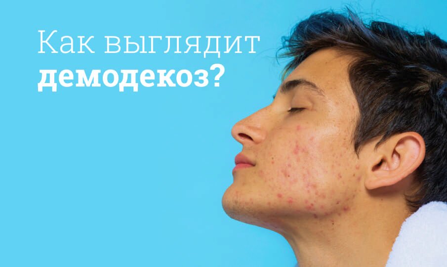 Демодекоз: симптомы и лечение