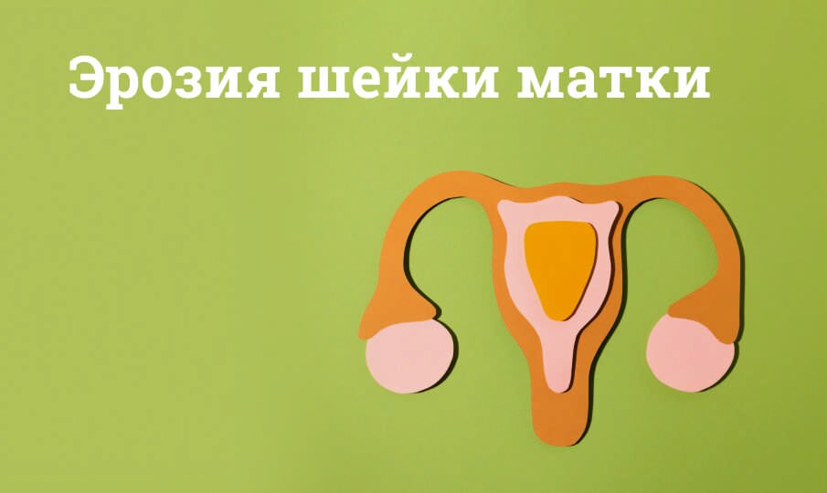 Эрозия шейки матки: симптомы и лечение