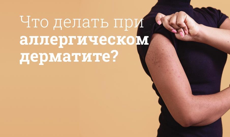 Лечение аллергического дерматита